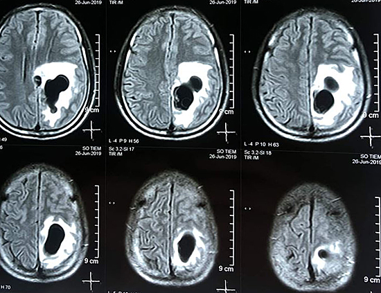 Hình chụp phim 5 ổ sán trên não người đàn ông ở bệnh viện Hữu nghị Đa khoa Nghệ An.